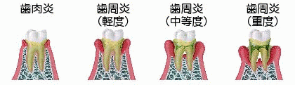 ＜図解＞歯槽膿漏（歯周病）の進行過程